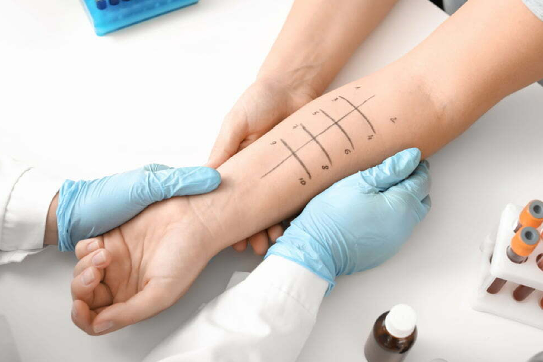 Illustration of Allergy Skin Testing