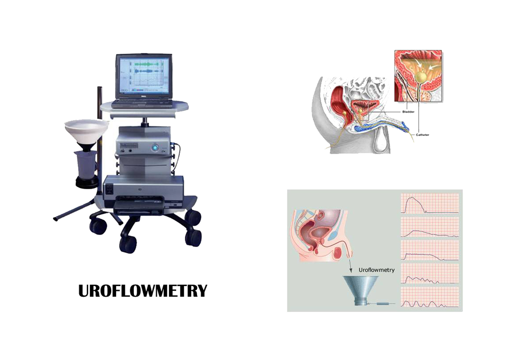 Illustration of Uroflowmetry