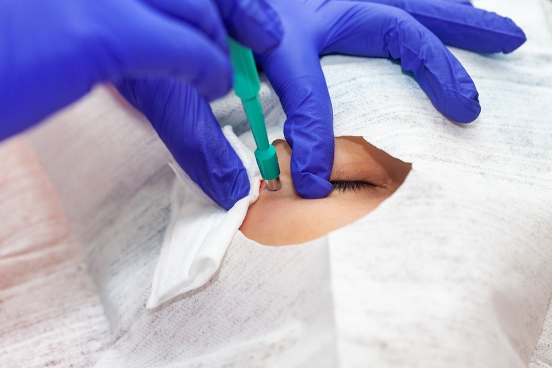 Illustration of Punch Biopsy