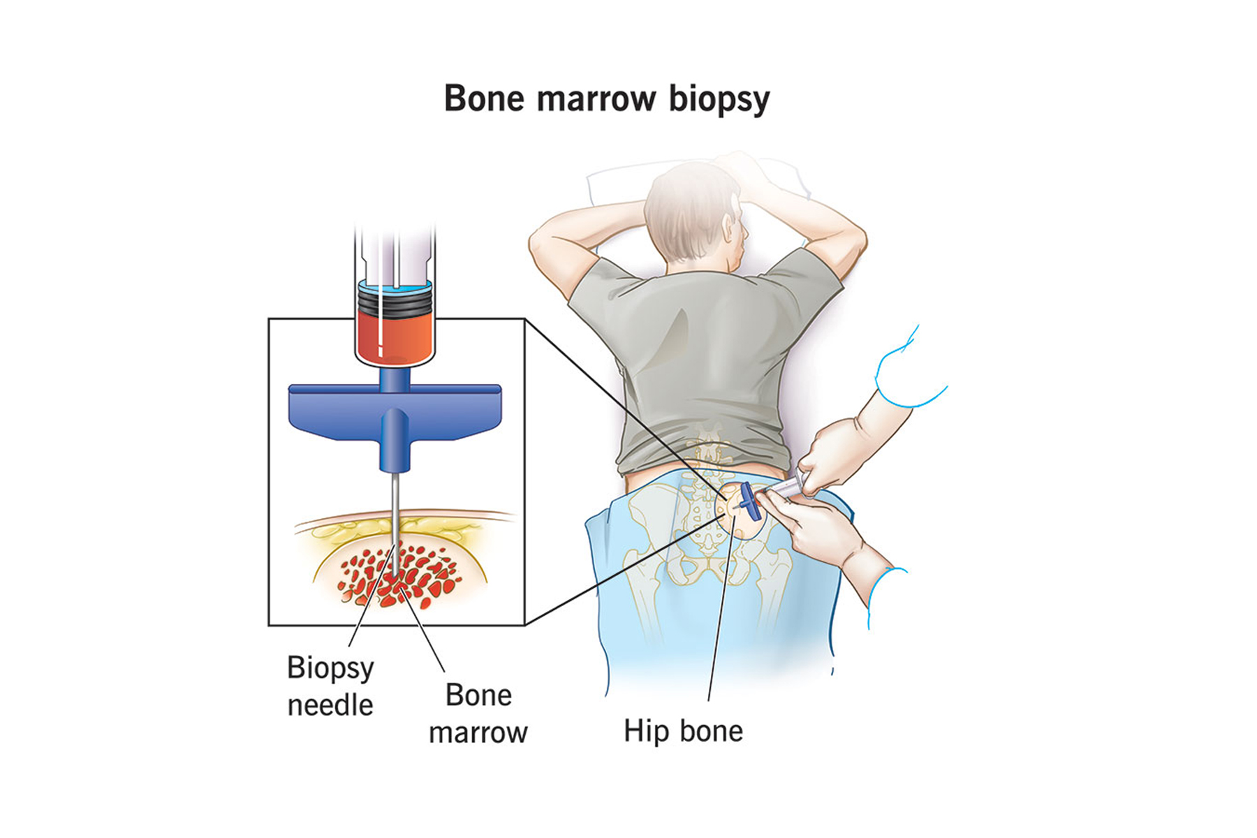 Illustration of Bone Marrow Biopsy