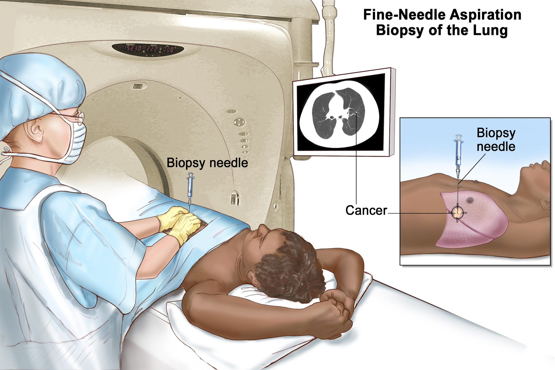 Illustration of CT-Guided Biopsy
